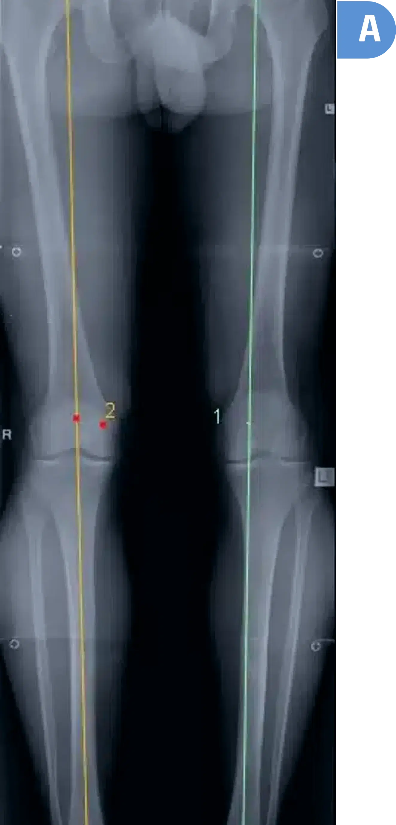 x-rays A