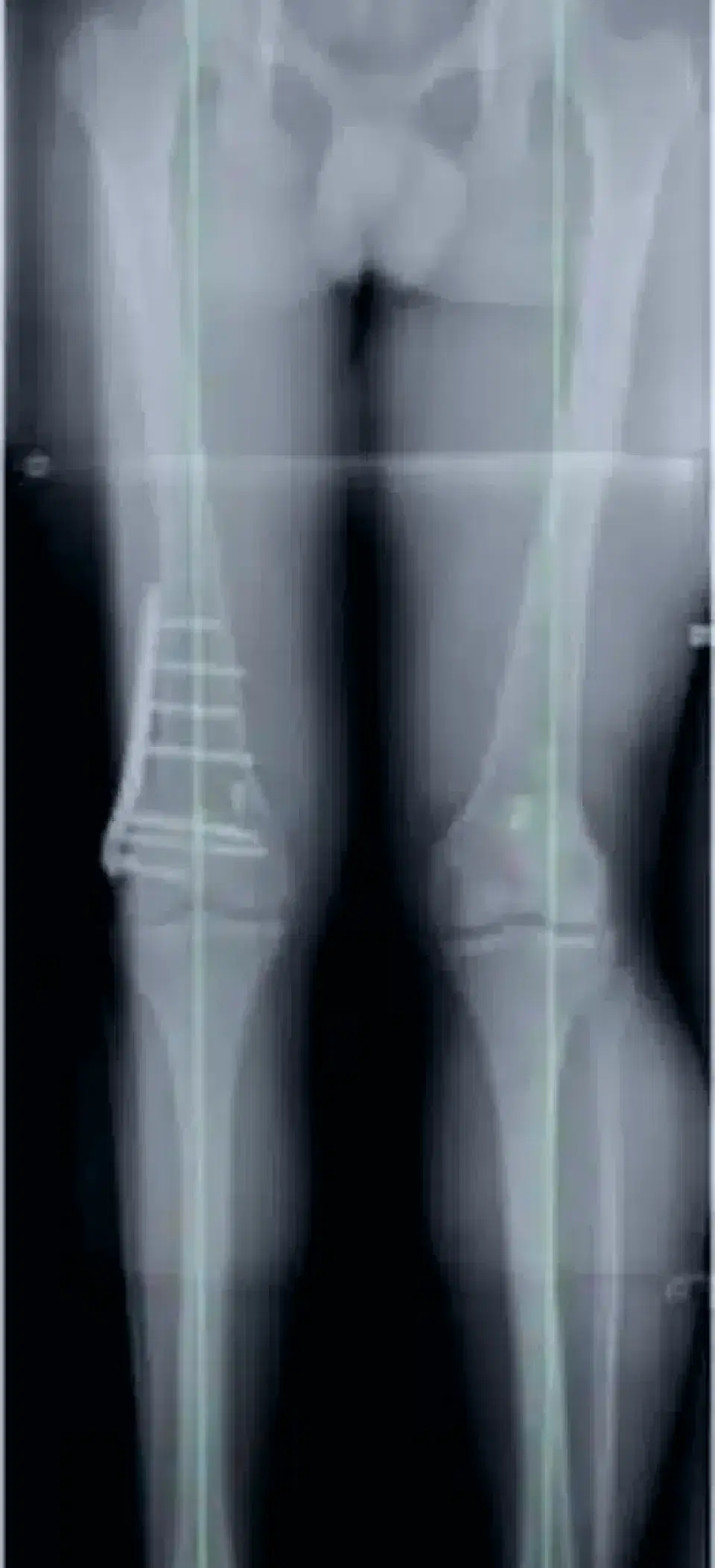 Pre surgery long x-ray