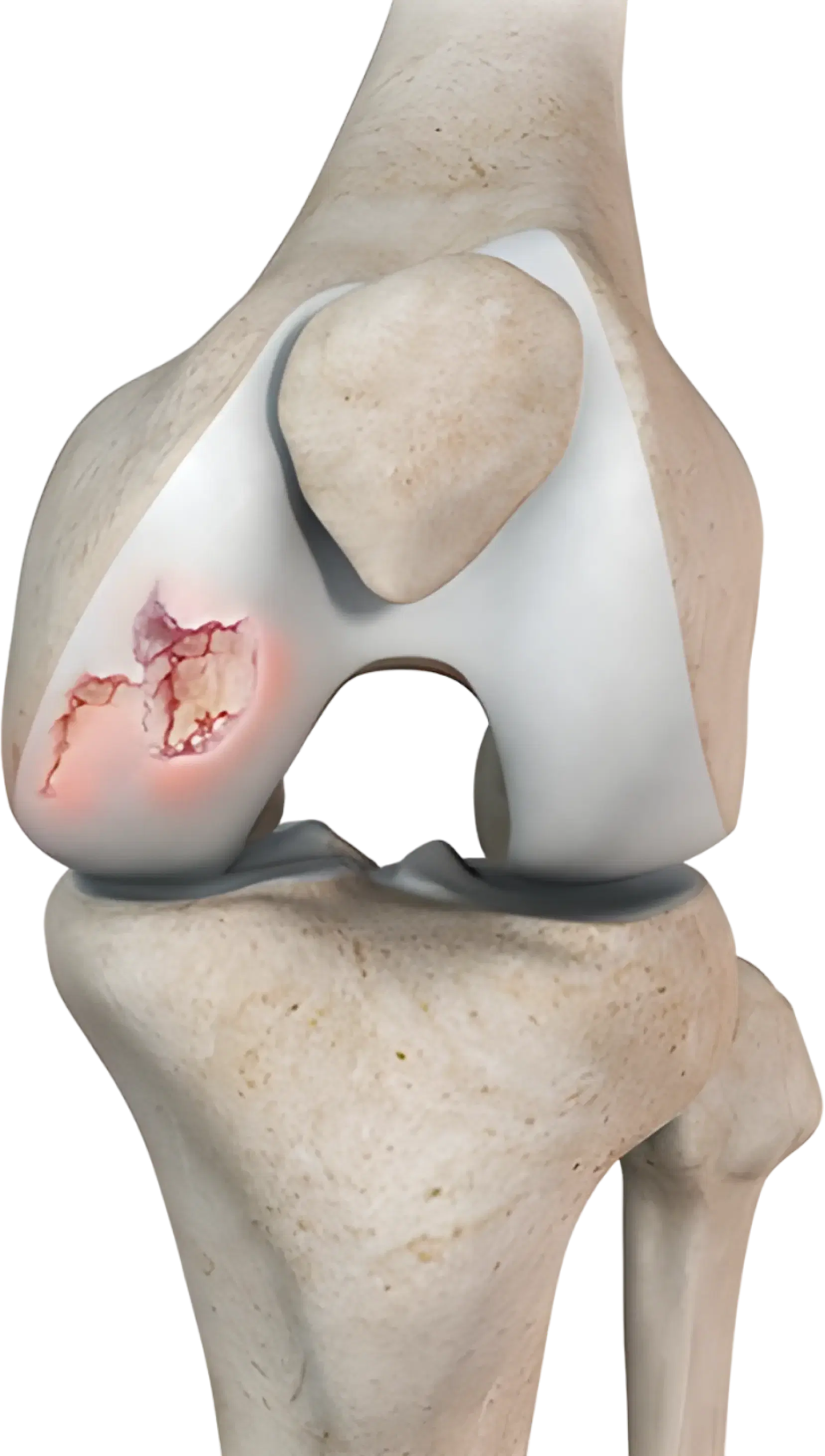 Cartilage Reconstruction