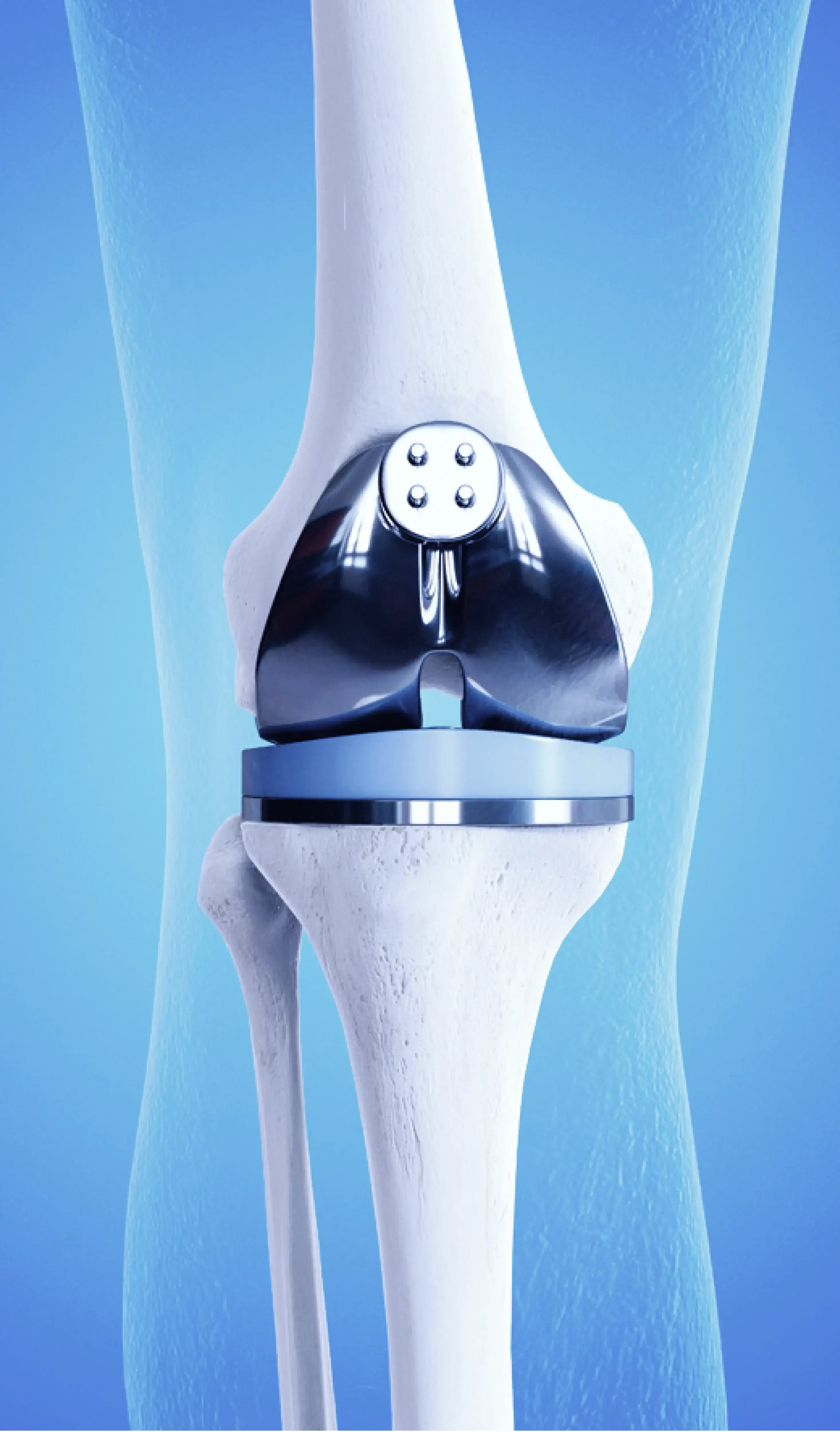 knee replacement prostheses