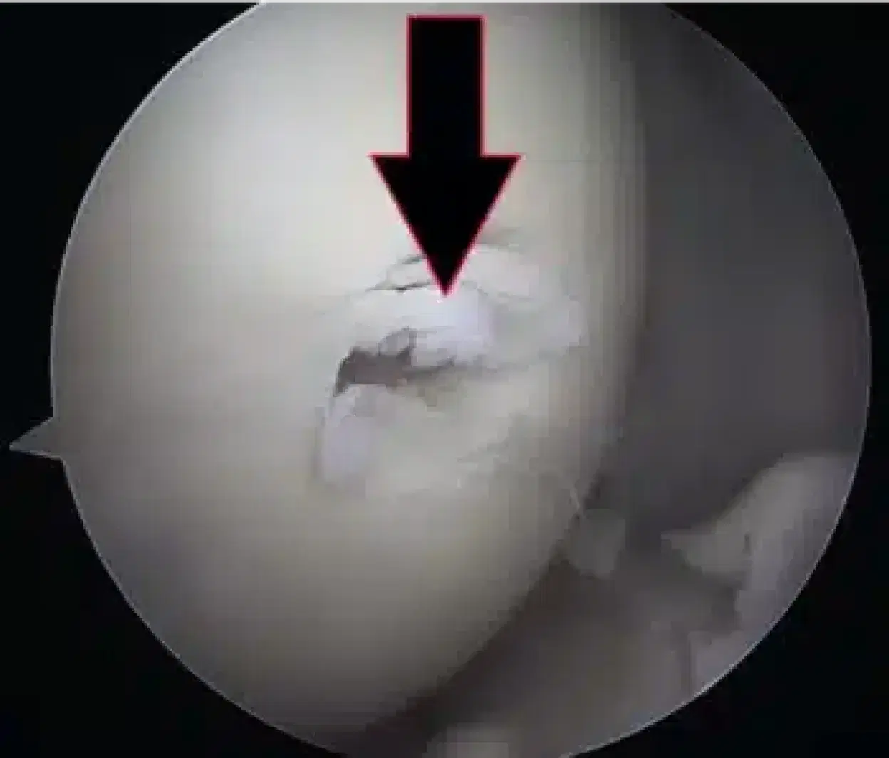 cartilage Reconstruction image 1 