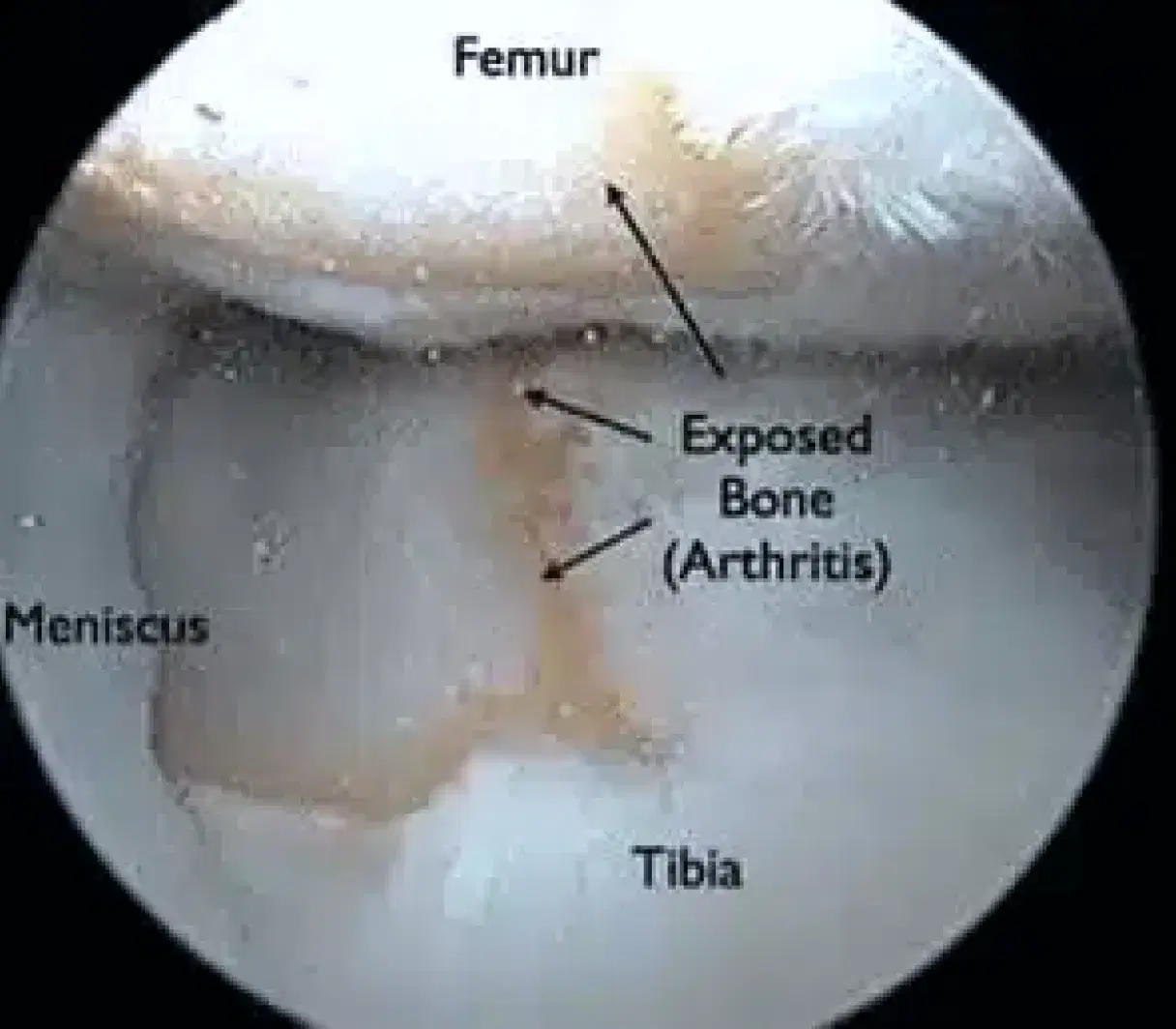 cartilage Reconstruction image 2 