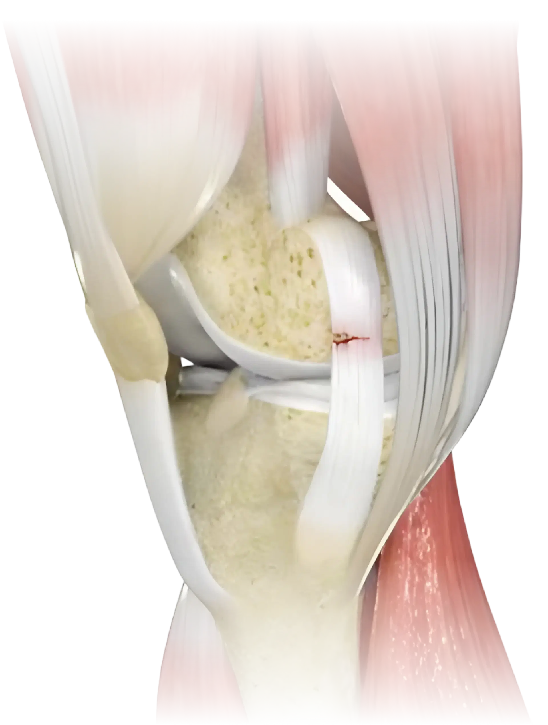 Knee Ligament Injuries illustration