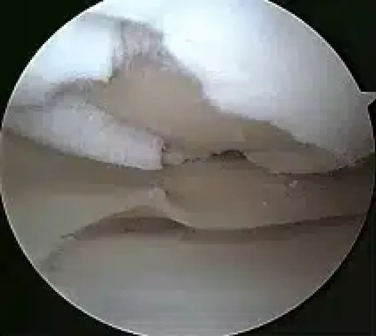 microfracture picture 1