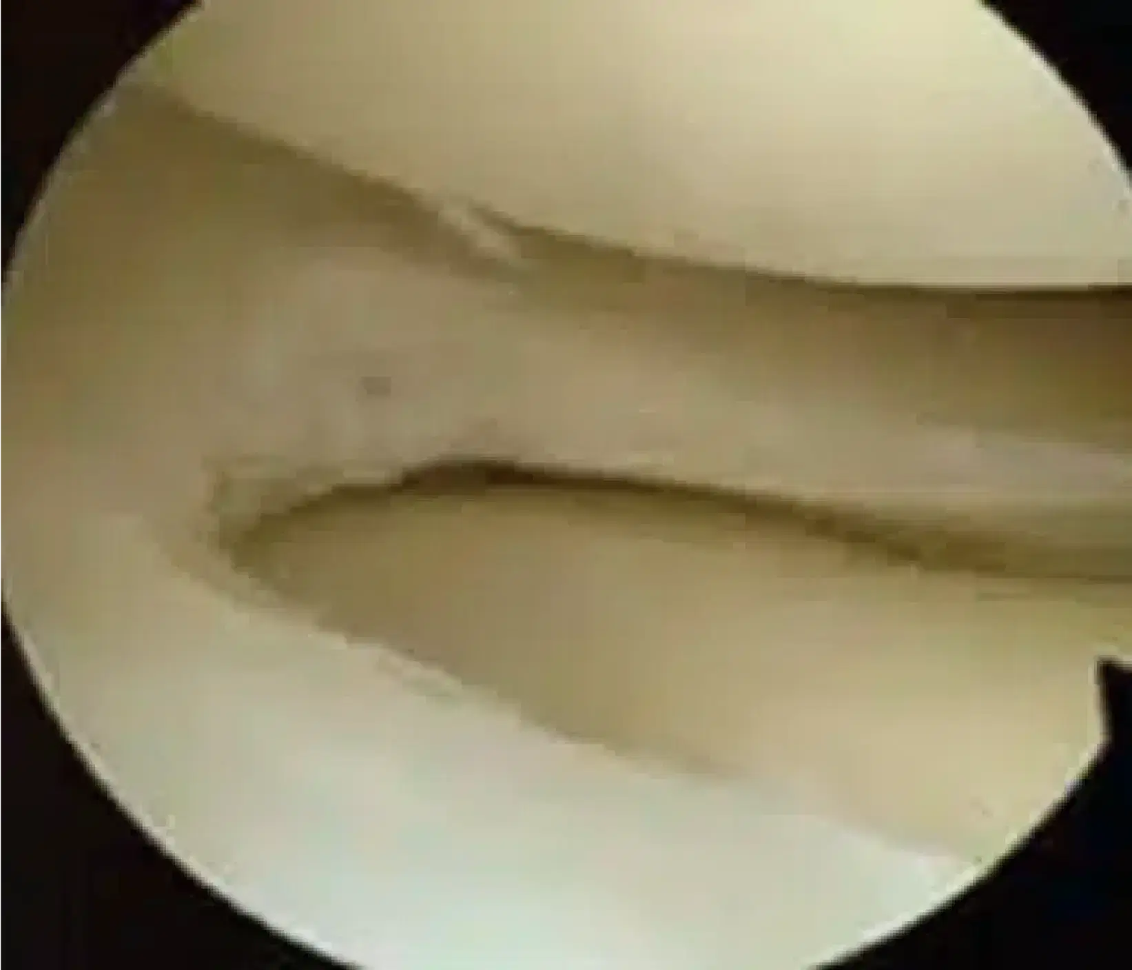 meniscus post meniscectomy
