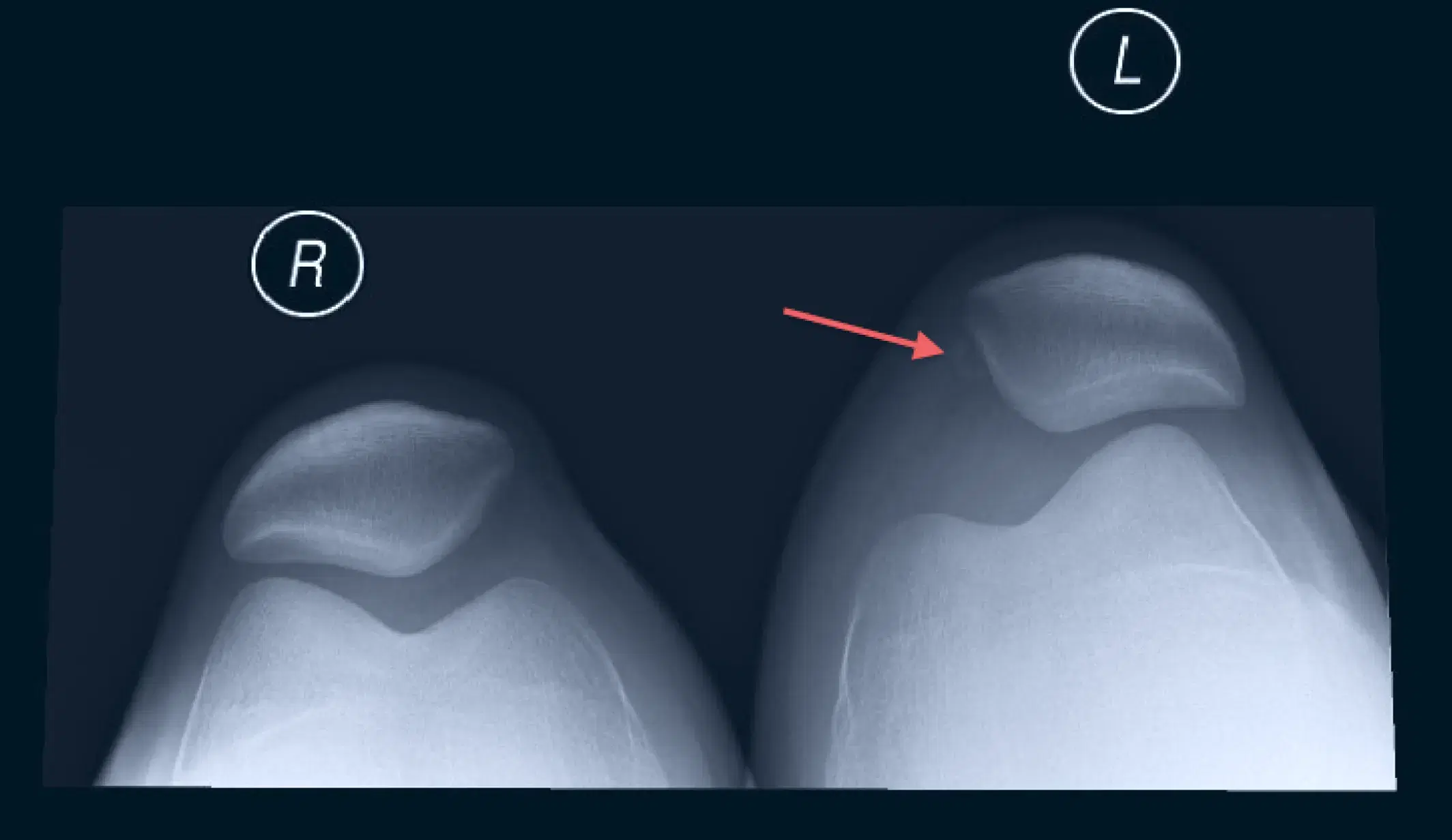 Patella subluxation (partial dislocation) on the right