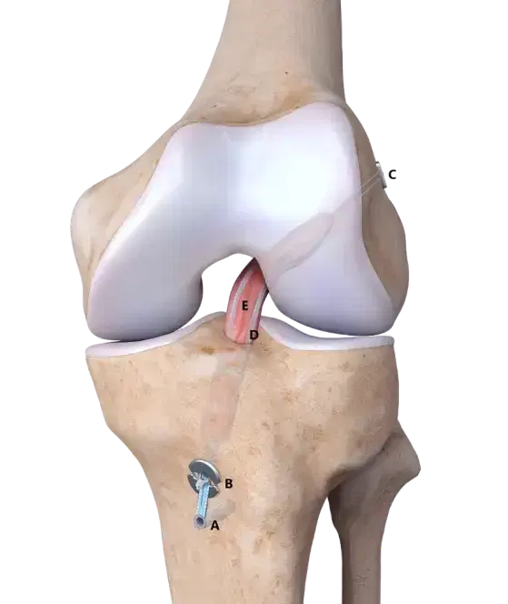 ACL Reconstruction example